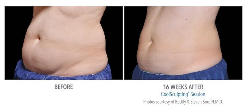 CoolSculpting session | Before and After Photo | Allure Dermatology | Edinburg, TX