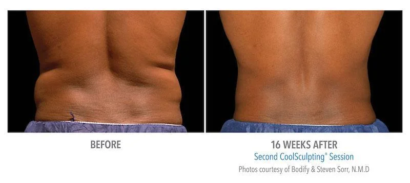 Coolsculpting Elite Specialist before after four by Allure Dermatology in Edinburg TX