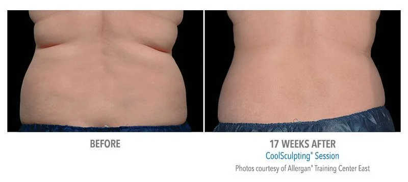 Coolsculpting Elite Specialist before after three by Allure Dermatology in Edinburg TX