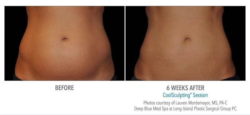 Coolsculpting Elite Specialist before after two by Allure Dermatology in Edinburg TX