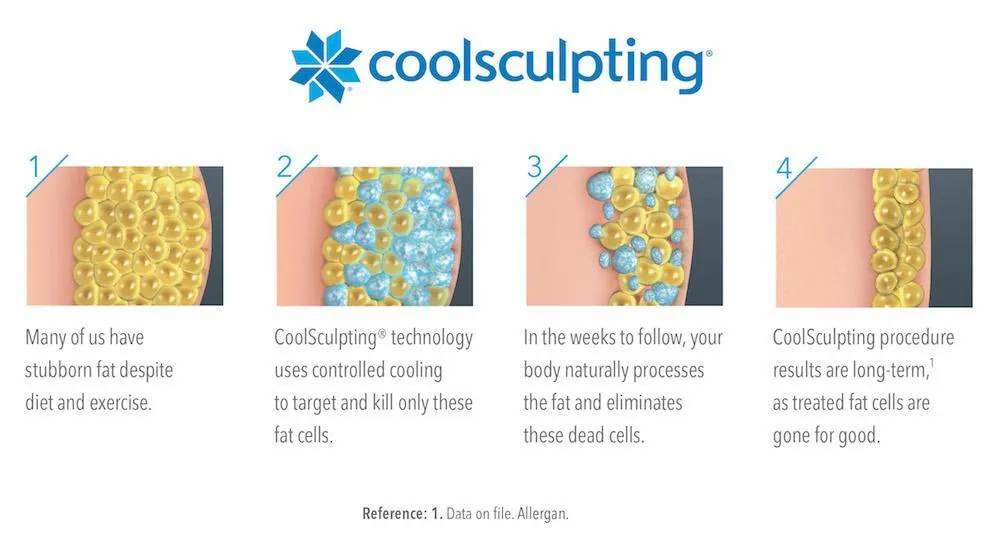 CoolSculpting infographic image | Allure Dermatology | Edinburg, TX