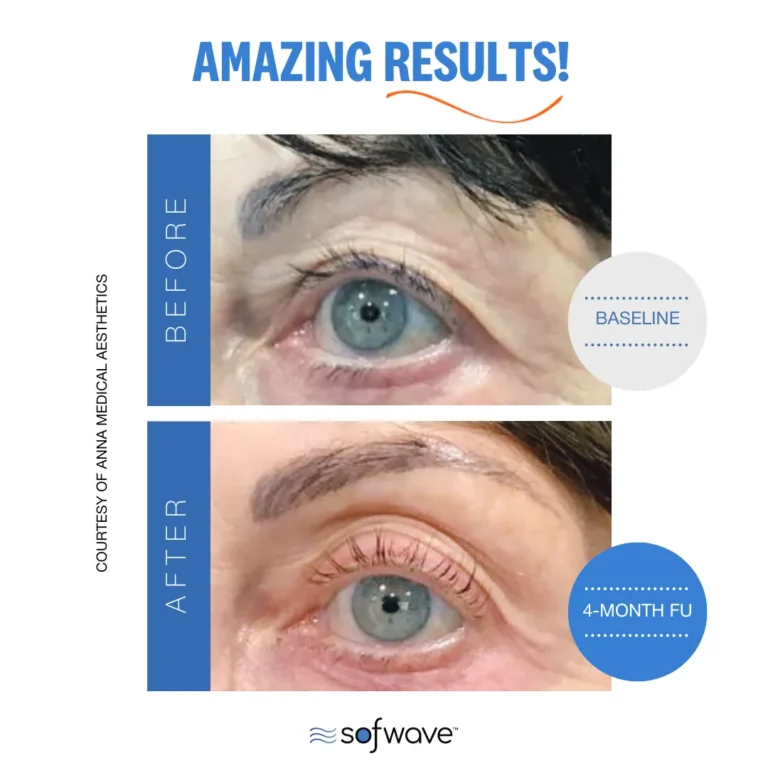 Droopy eyelids treatment | Before and After Photo | Allure Dermatology | Edinburg, TX