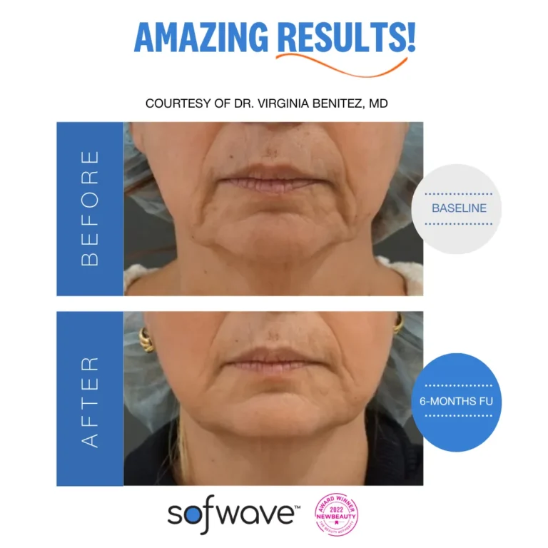 Sofwave for wrinkles around mouth | Before and After Photo | Allure Dermatology | Edinburg, TX