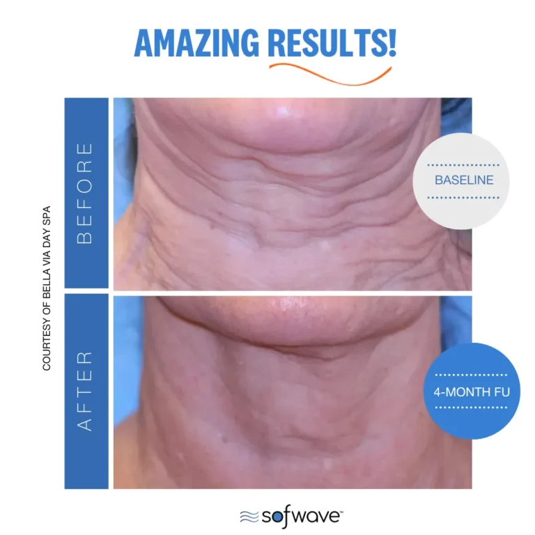 Sofwave for Neck tightening | Before and After Photo | Allure Dermatology | Edinburg, TX