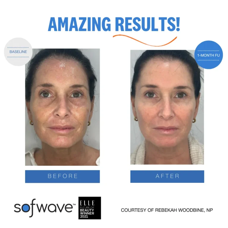 Sofwave Before and After Photo | Allure Dermatology | Edinburg, TX