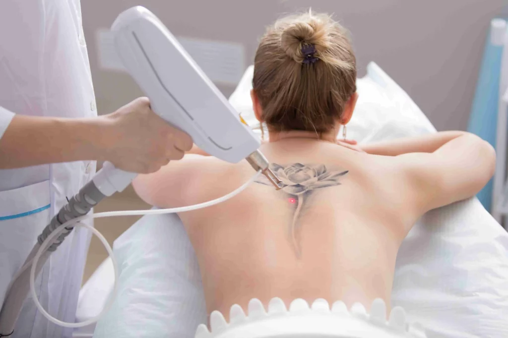 a woman getting tattoo removal using laser treatment on her back | Allure Dermatology | Edinburg, TX