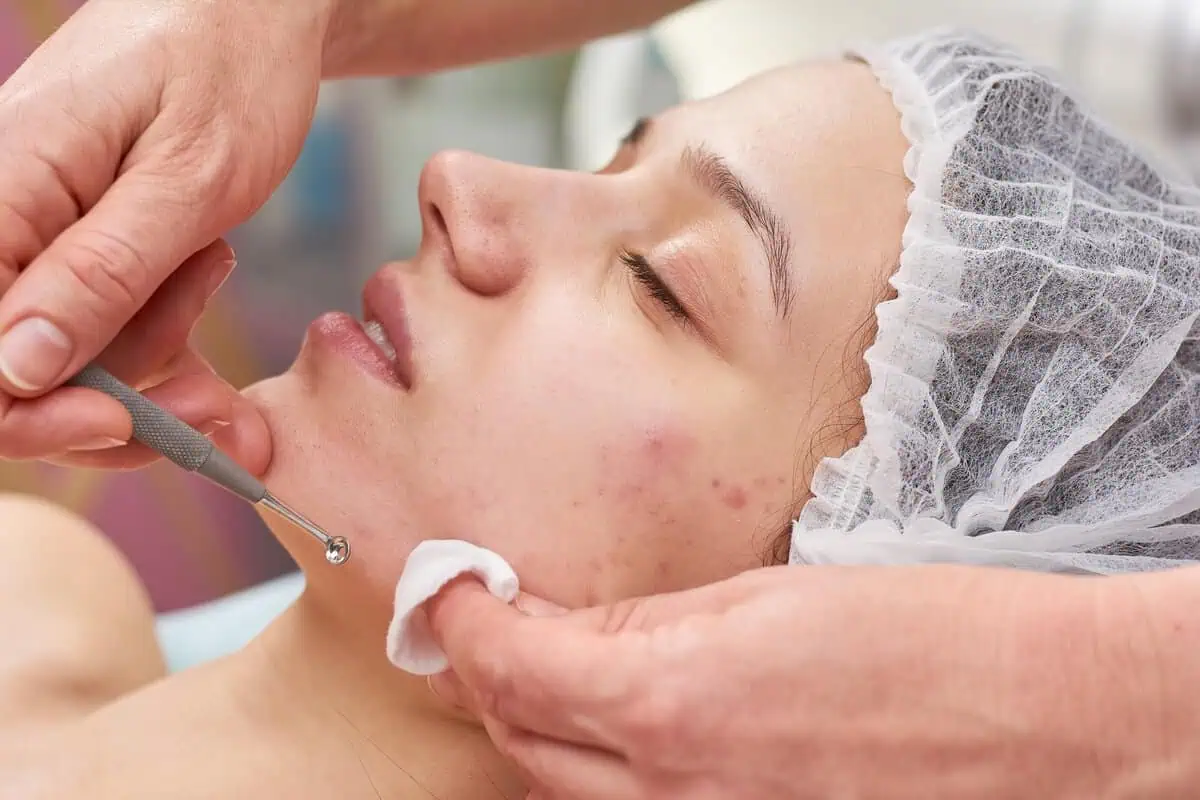 Acne Treatment by Allure Dermatology in Edinburg TX