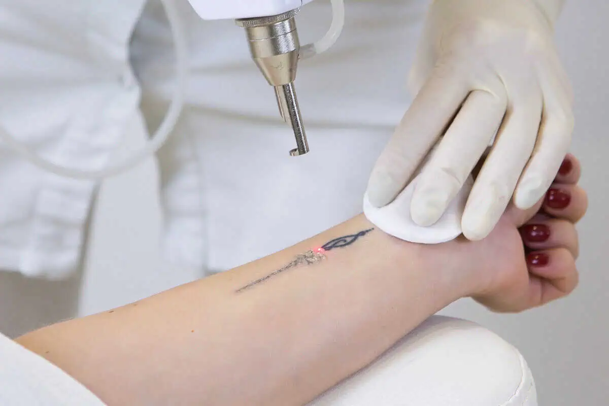 Laser Tattoo Removal | Allure Dermatology