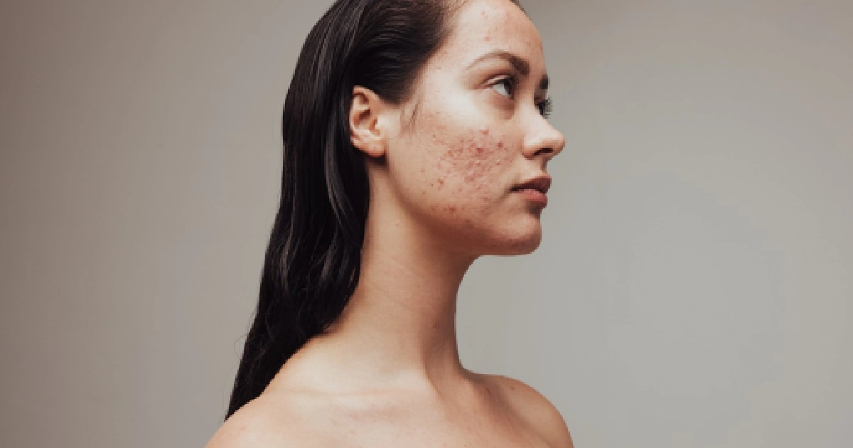 Women receiving Adult Acne treatment in Edinburg TX