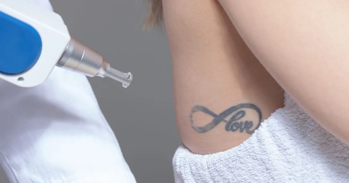 Laser Tattoo Removal treatment on a patient’s skin in Edinburg TX