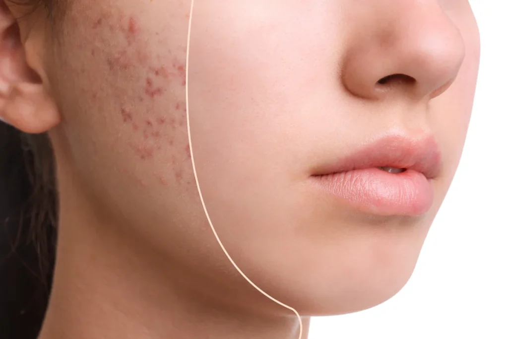 Before and after comparison of AviClear severe acne treatment at Allure Dermatology
