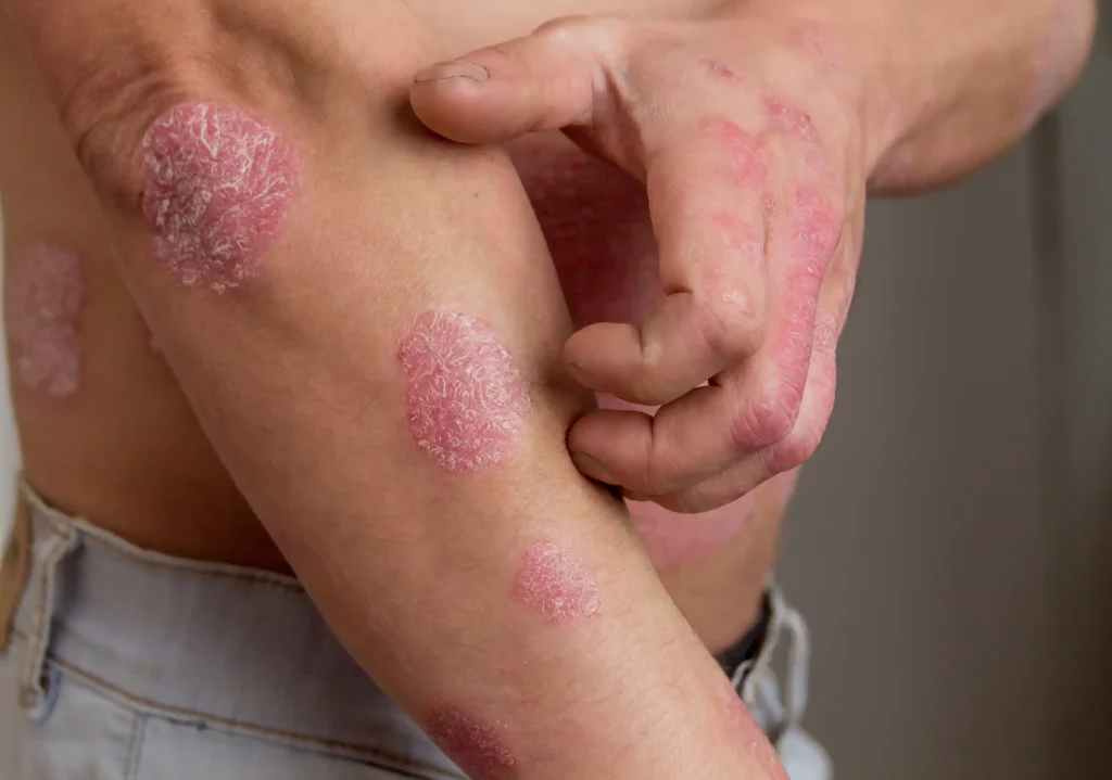 Woman with visible psoriasis symptoms before treatment at Allure Dermatology in Edinburg, TX