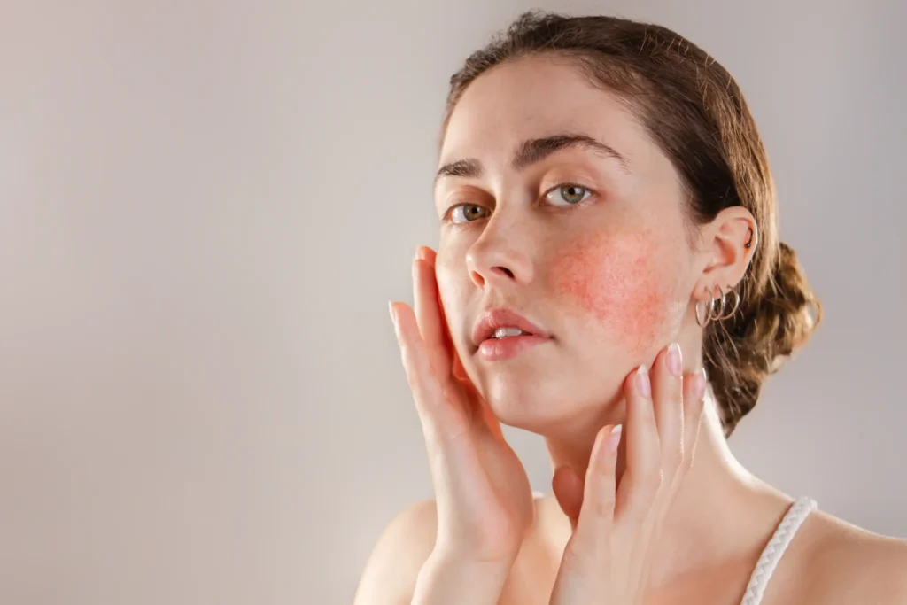 Woman receiving rosacea treatment from a dermatologist at Allure Dermatology in Edinburg, TX