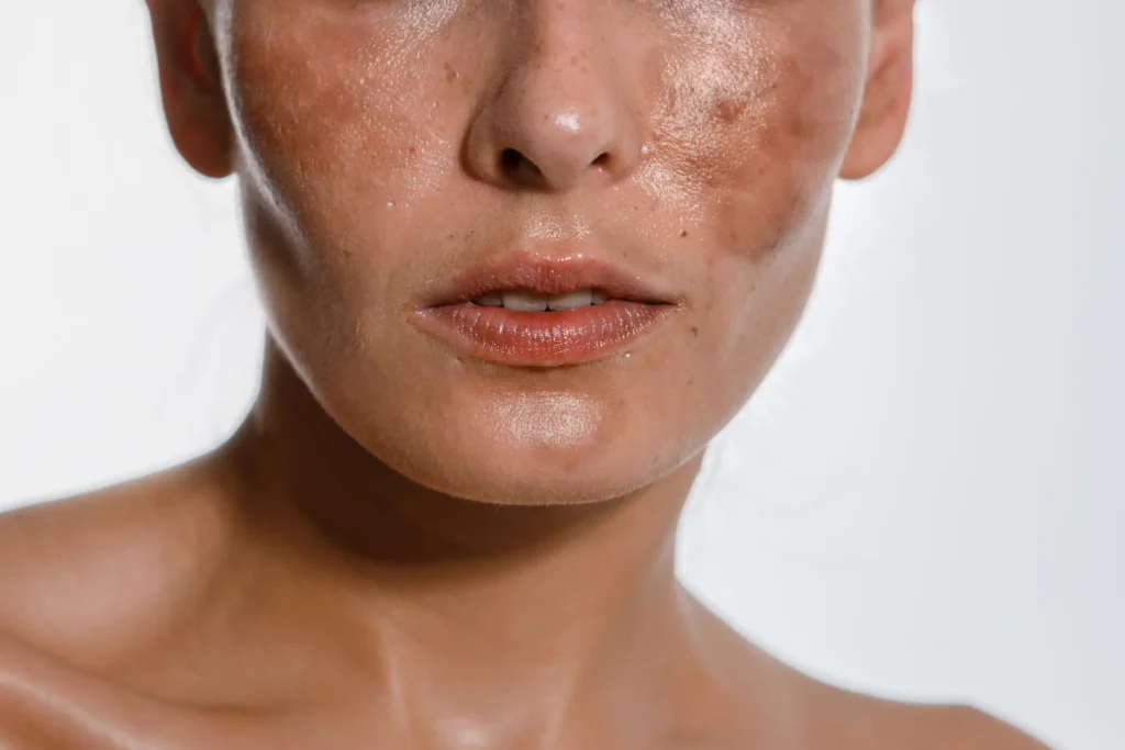 Woman with visible hyperpigmentation on her skin at Allure Dermatology in Edinburg, TX